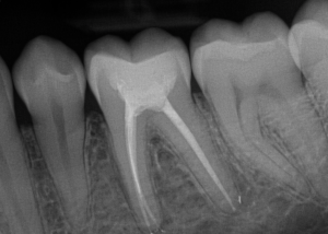 x-ray tooth